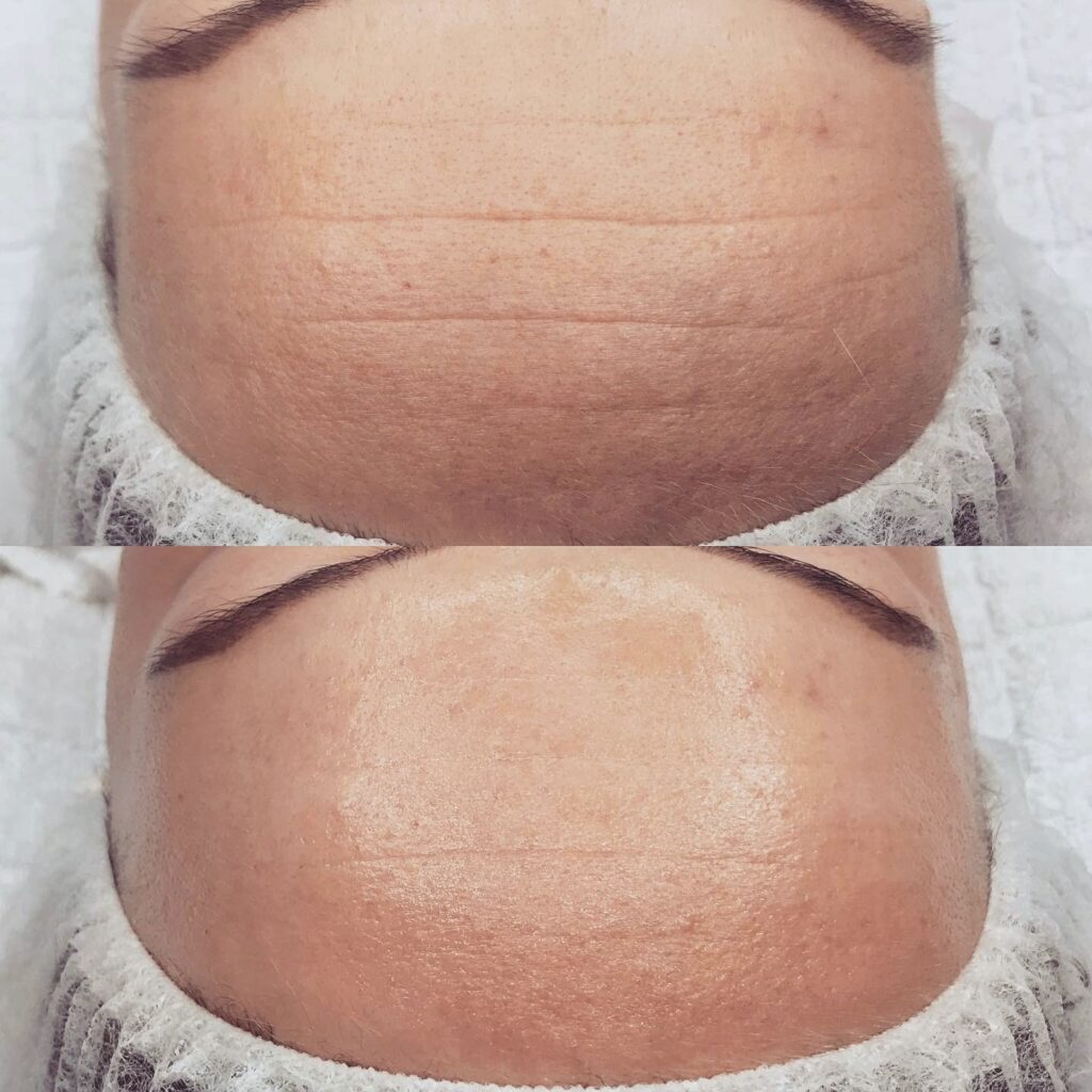 Kosmetické ošetření pleti – chemický peeling bez podráždění